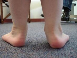 Deformità del piede piatto valgo in un bambino