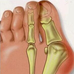 Le ragioni di Valgus