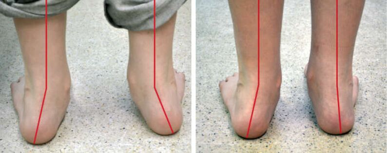 Valgus Gambe