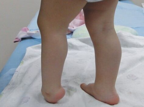 I primi sintomi della deformazione di Valgus del piede