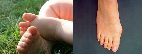 Valgus Deformazione del primo dito del piede
